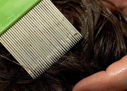 Stave The Itch Of Head Lice With At Home Remedies Review